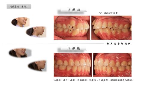 門牙歪斜